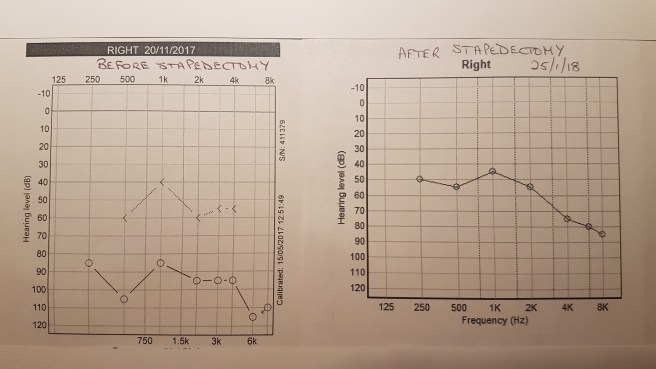 Right ear audiogram before and after