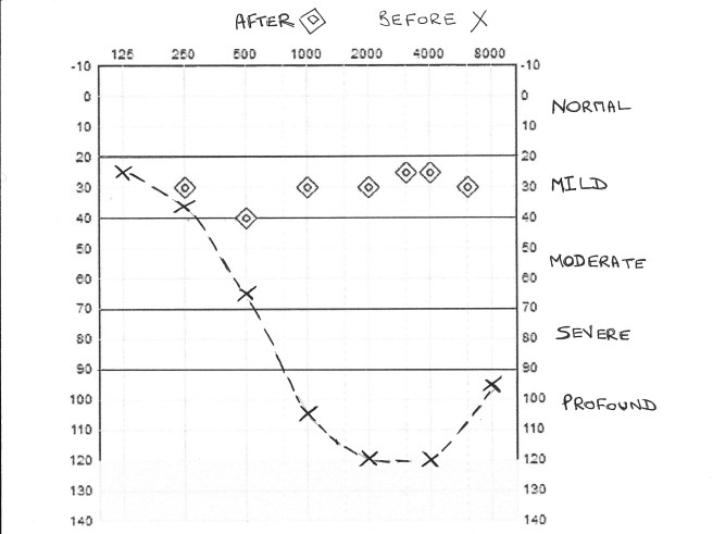 audiogram final